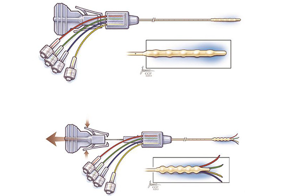 Cleveland Multiport Catheter shown in undeployed (top) and deployed (bottom) views